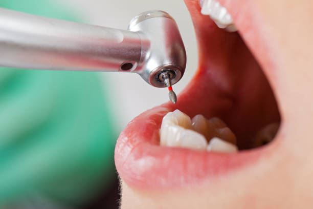 Best Chipped Tooth Repair Near Me  in Harrison, OH